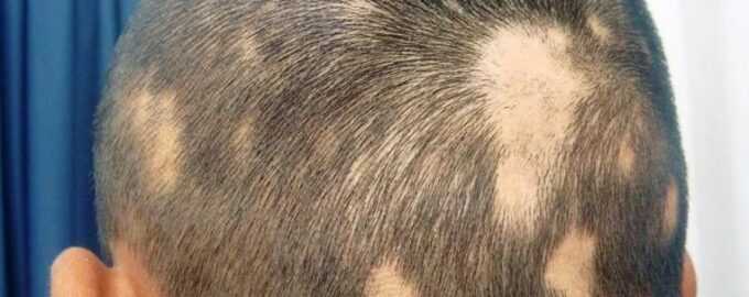 Как стресс влияет на волосы человека