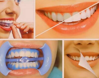 Отбеливание зубов у стоматолога